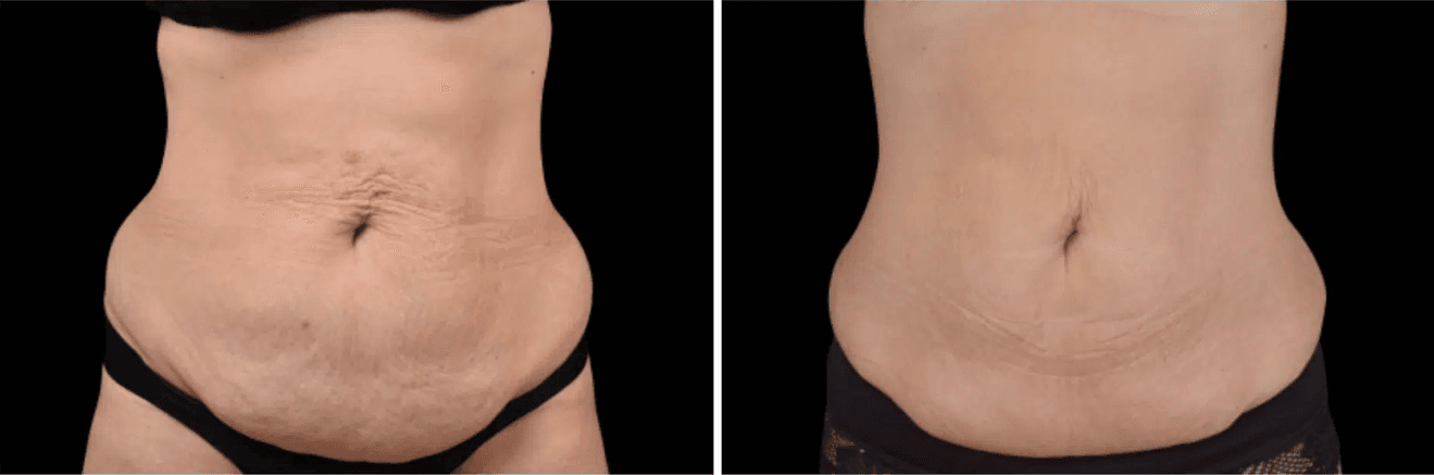 Emsculpt 1