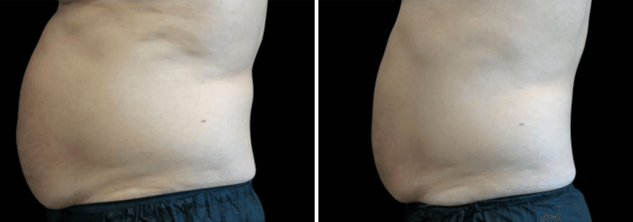 Emsculpt 2