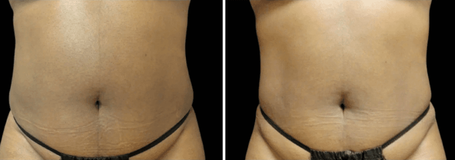 Emsculpt 4