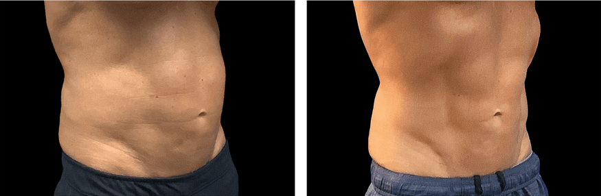 Emsculpt 5